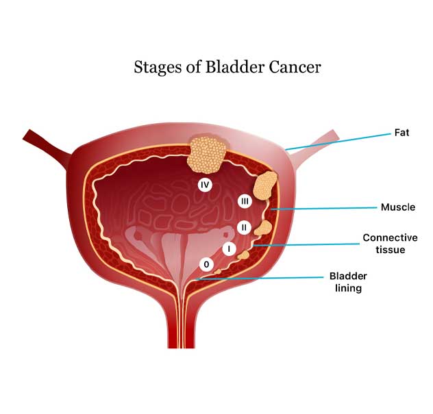 Bladder Cancer in Pune