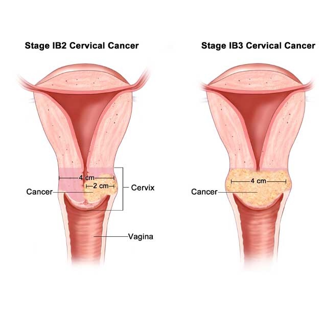 Cervical Cancer in Pune