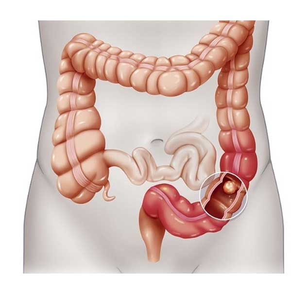 Colorectal Cancer in Pune