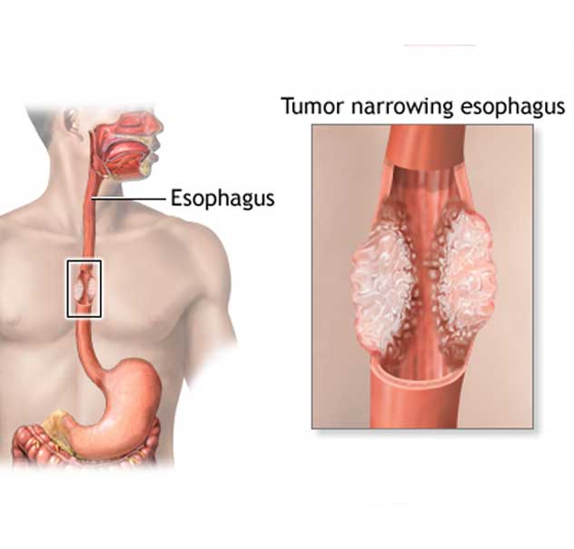 Esophagus Cancer in Pune