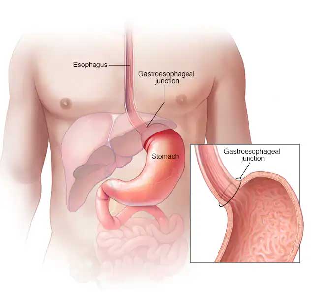 Gastric Cancer Hospitals, Doctors, Treatment, Centres