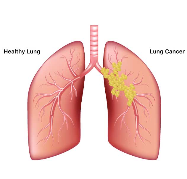 Lung Cancer in pune
