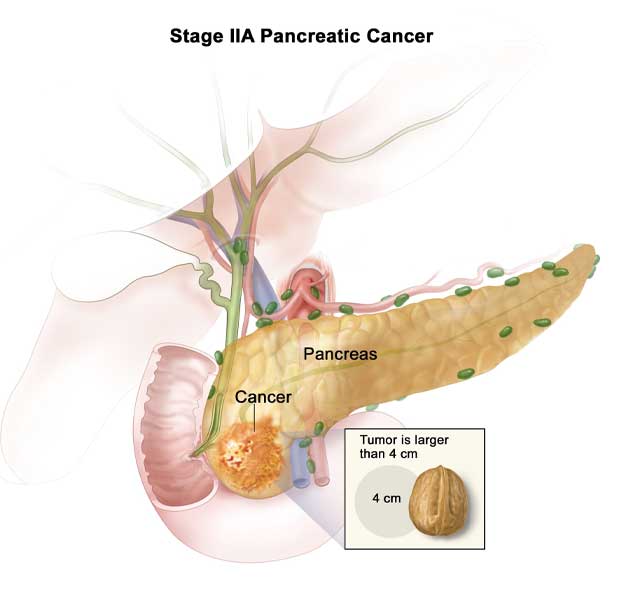 Pancreatic Cancer in Pune