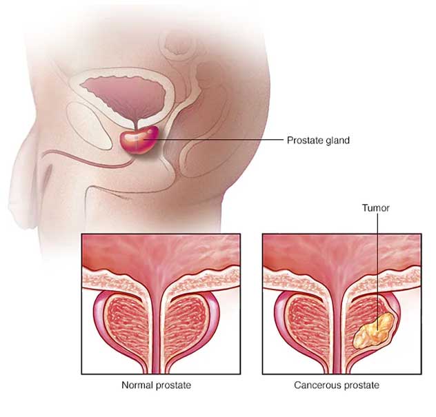 Prostate Cancer in Pune
